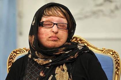 آمنه بهرامی؛ قربانی معروف اسیدپاشی بعد از ۱۸ سال دوباره شکایت کرد/ پشیمانم که بخشیدم!
